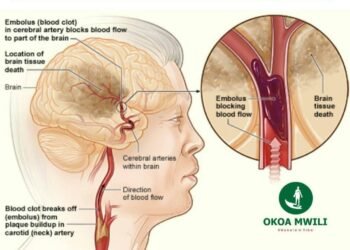 Dalili za Ugonjwa wa Kiharusi, Sababu na Tiba