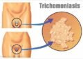 Dalili za Ugonjwa wa Trichomoniasis, Sababu na Tiba