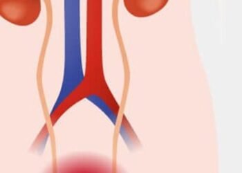 Dalili za Saratani ya Kibofu cha Mkojo, Sababu na Tiba