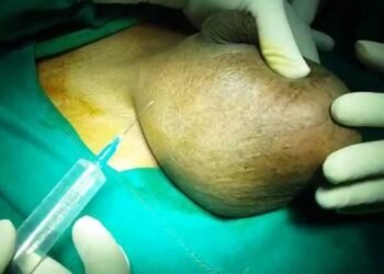 Fahamu Ugonjwa wa Busha, Sababu, Dalili Zake na Tiba