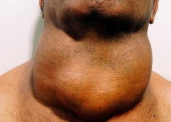 Fahamu Ugonjwa wa Goita, Sababu, Dalili Zake na Tiba