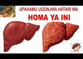 Dalili za Ugonjwa wa Ini, Sababu na Tiba