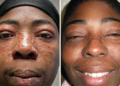 Fahamu Ugonjwa wa Lupus, Sababu, Dalili Zake na Tiba