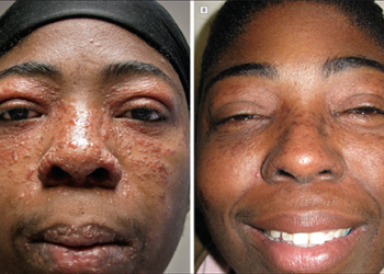 Fahamu Ugonjwa wa Lupus, Sababu, Dalili Zake na Tiba