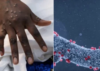 Fahamu Ugonjwa wa Marburg, Sababu, Dalili Zake na Tiba