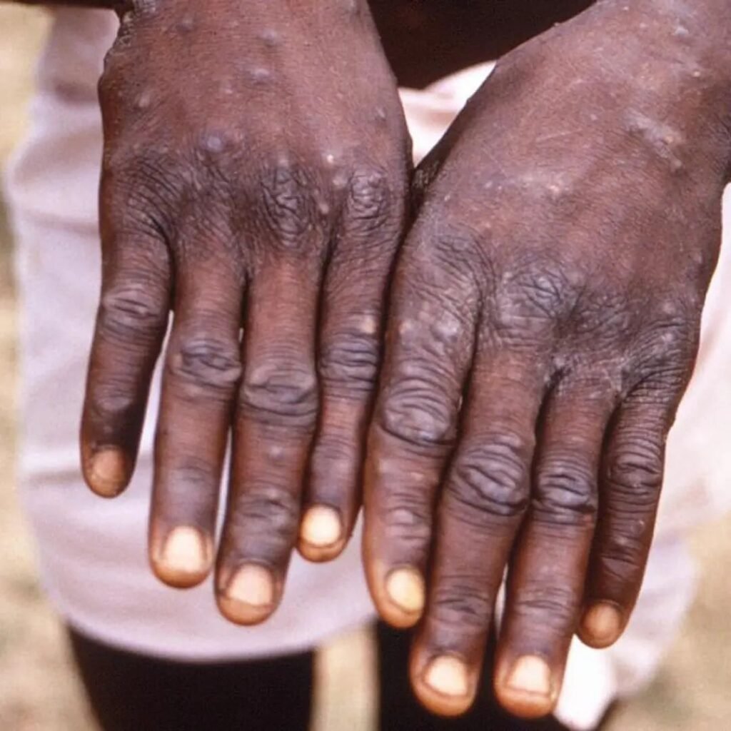 Fahamu Ugonjwa wa Ngozi, Sababu, Dalili Zake na Tiba