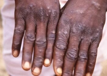 Fahamu Ugonjwa wa Ngozi, Sababu, Dalili Zake na Tiba