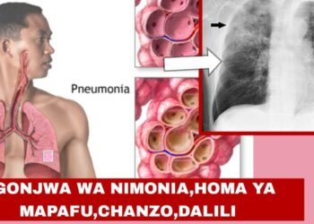 Dalili za Ugonjwa wa Nimonia, Sababu na Tiba