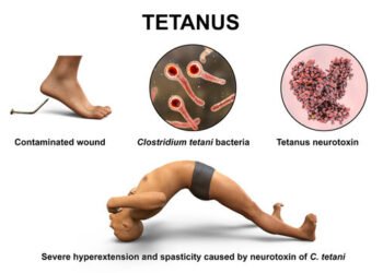 Fahamu Ugonjwa wa Pepopunda, Sababu, Dalili Zake na Tiba