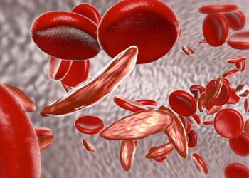 Zifahamu Dalili za ugonjwa wa Anemia, Sababu na Tiba