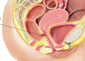 Fahamu ugonjwa wa Fistula, Sababu, Dalili zake na Tiba