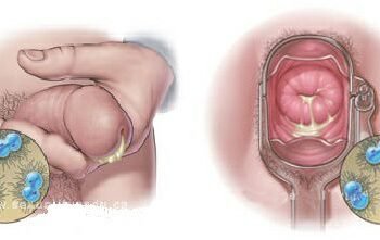 Dalili za ugonjwa wa Gono, Sababu na Tiba