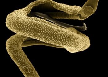 Dalili za ugonjwa wa Kichocho, Sababu na Tiba