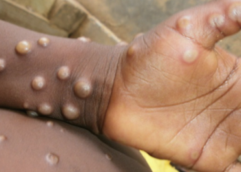 Fahamu ugonjwa wa Mpox, Sababu, Dalili zake na Tiba