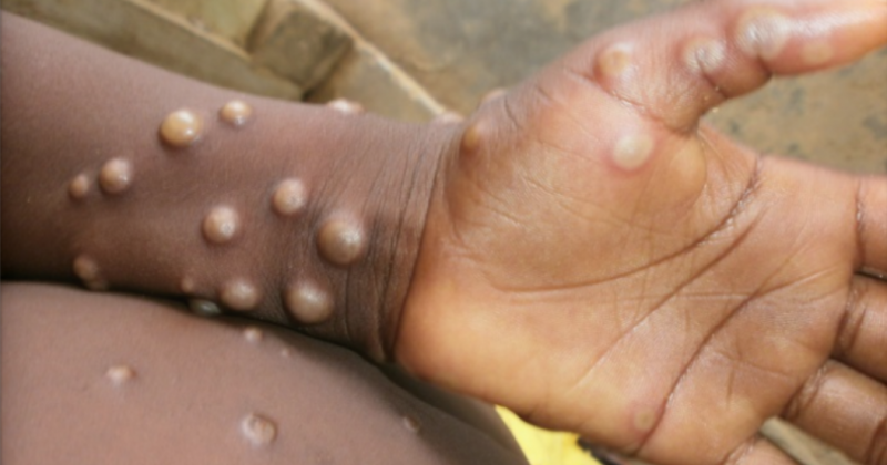 Fahamu ugonjwa wa Mpox, Sababu, Dalili zake na Tiba