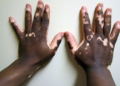 Fahamu ugonjwa wa Vitiligo, Sababu, Dalili zake na Tiba