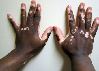 Fahamu ugonjwa wa Vitiligo, Sababu, Dalili zake na Tiba