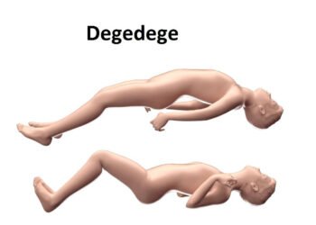 Fahamu ugonjwa wa degedege, Sababu, Dalili zake na Tiba