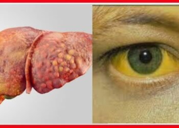 Dalili za ugonjwa wa homa ya manjano, Sababu na Tiba