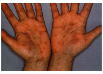 Fahamu Ugonjwa wa Kaswende,