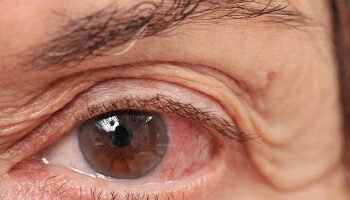 Dalili za Ugonjwa wa Presha ya Macho, Sababu na Tiba