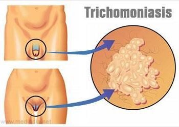 Dalili za Ugonjwa wa Trichomoniasis, Sababu na Tiba