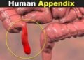 ugonjwa wa Appendicitis