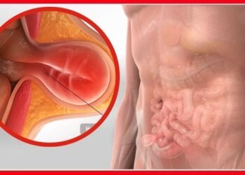 ugonjwa wa Hernia