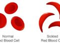 ugonjwa wa Sickle Cell (seli mundu)