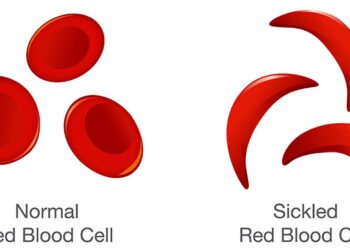 ugonjwa wa Sickle Cell (seli mundu)